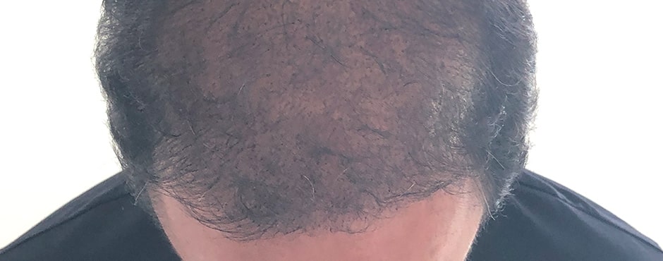 Sian Dellar Scalp Micropigmention Hair Tattoo After 2