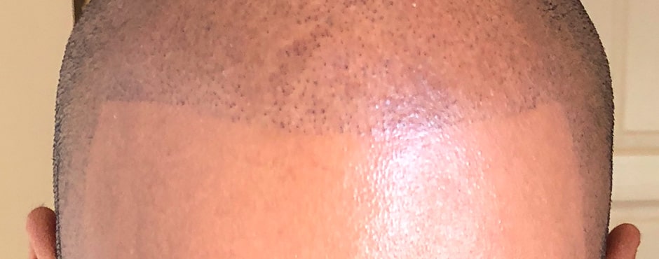 Sian Dellar Scalp Micropigmention Hair Tattoo After 3